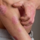 Eczema is a sign of food intolerance