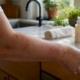 Close-up of arm with mild hives and redness